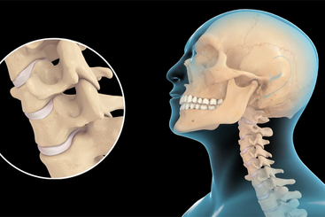 Cervical Disc Injury.jpg