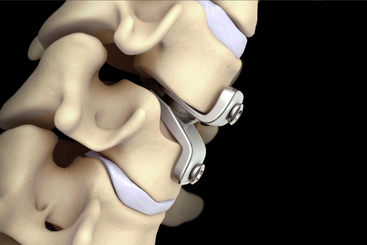Cervical Disc Replacement.jpg