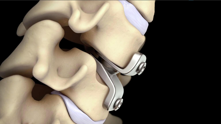 Cervical Disc Replacement.jpg