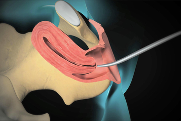Dilation and Curettage (D&C).jpg