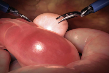 Robotic Radical Cystectomy (Male).jpg