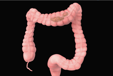 Irritable Bowel Syndrome (IBS).jpg