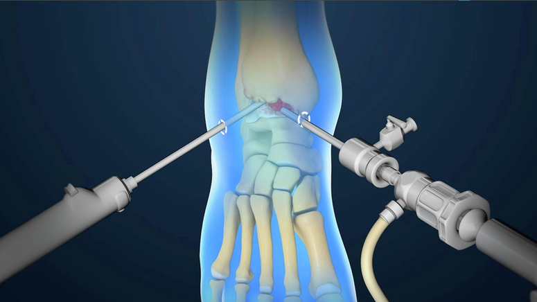 Ankle Arthroscopy.jpg