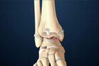 Anterior Ankle Fusion.jpg