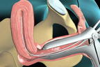 Endometrial Biopsy.jpg