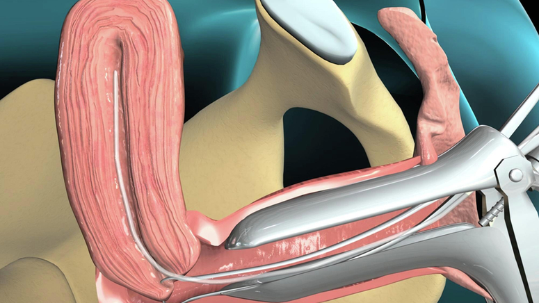 Endometrial Biopsy.jpg