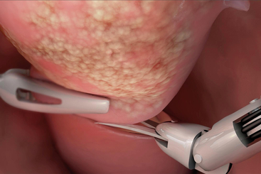 Robotic Hysterectomy.jpg