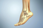 Achilles Tendon Rupture and Repair.jpg