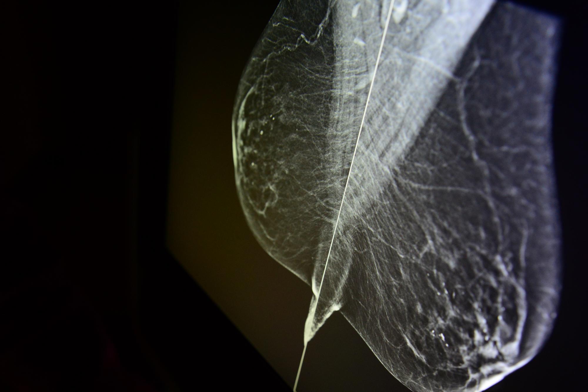 Imaging-guided Localization Procedures Offered at Mercy - Baltimore