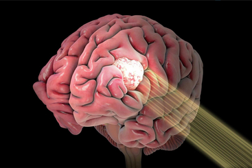 Intensity Modulated Radiation Therapy.jpg