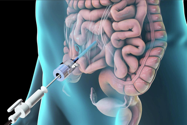 Laparoscopic Lysis of Abdominal Adhesions.jpg