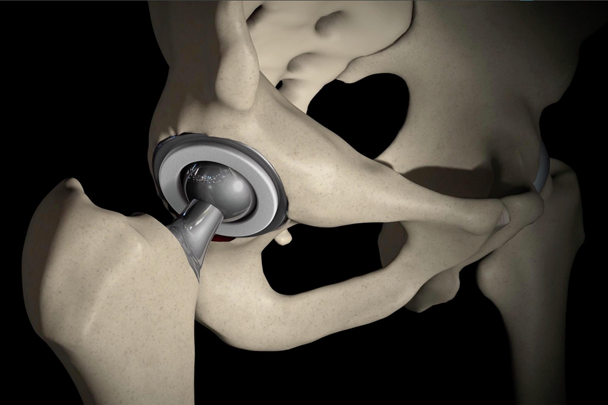 Anterior Approach Hip Replacement Offered by Top Orthopedic
