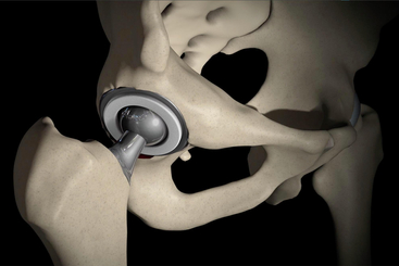 Minimally Invasive Direct Total Hip Replacement.jpg