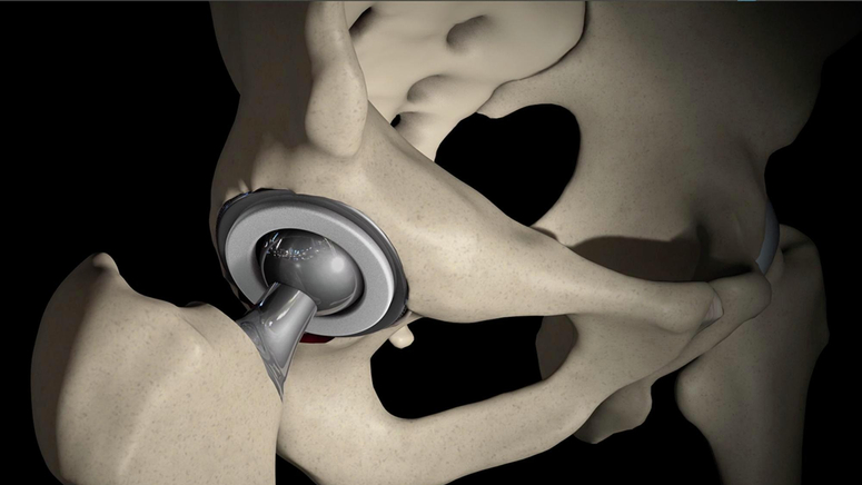Minimally Invasive Direct Total Hip Replacement.jpg