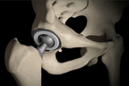 Minimally Invasive Direct Total Hip Replacement.jpg