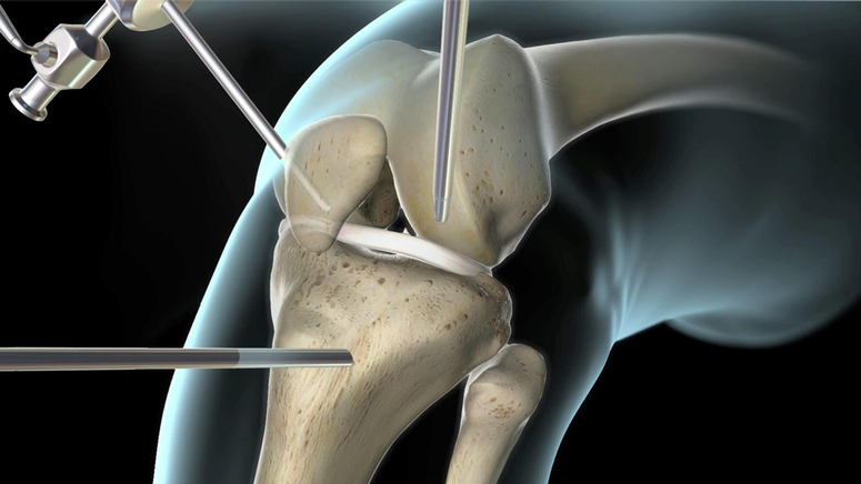 ACL (Anterior Cruciate Ligament) MCL (Medial Collateral Ligament