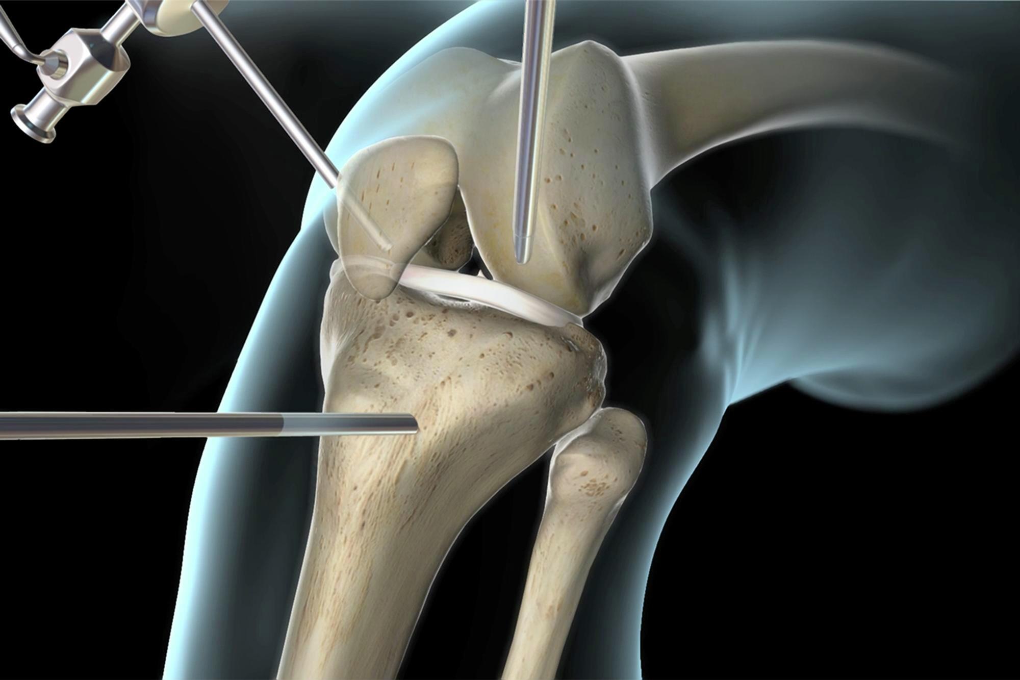 Ligament Tears (MCL, ACL) Treated by Orthopedic Doctors in Baltimore - Mercy
