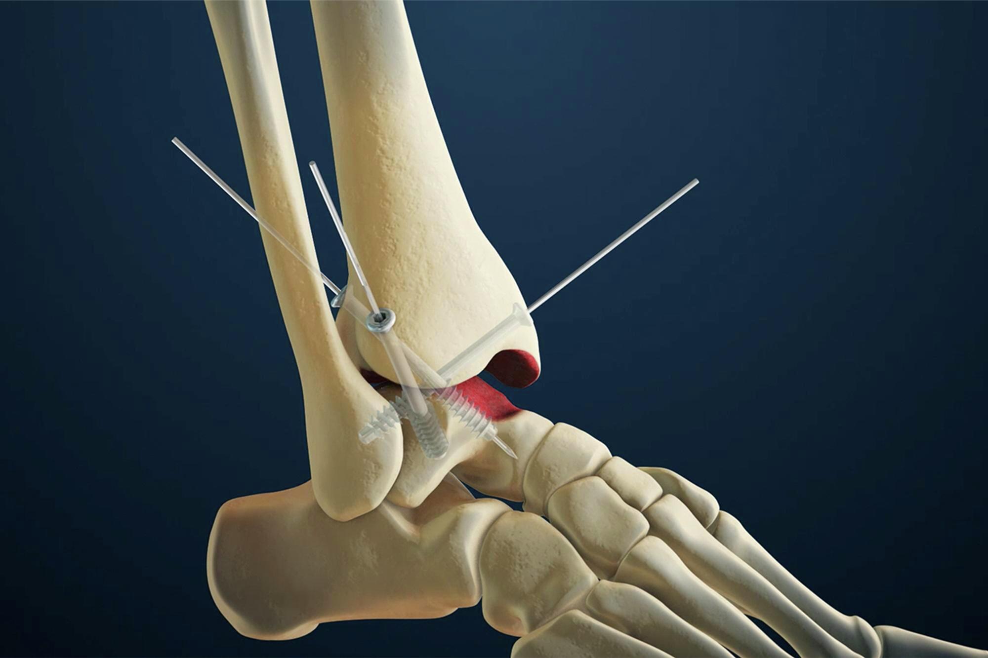 Ankle Arthritis Treatment Diagnosis Foot And Ankle Surgeons