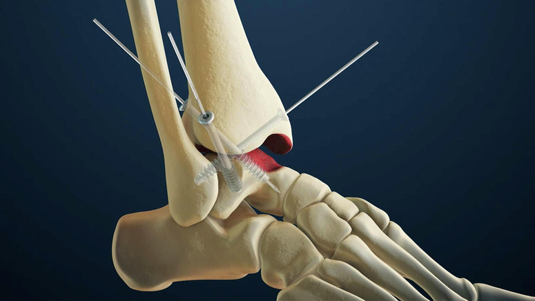 Arthroscopic Ankle Fusion.jpg
