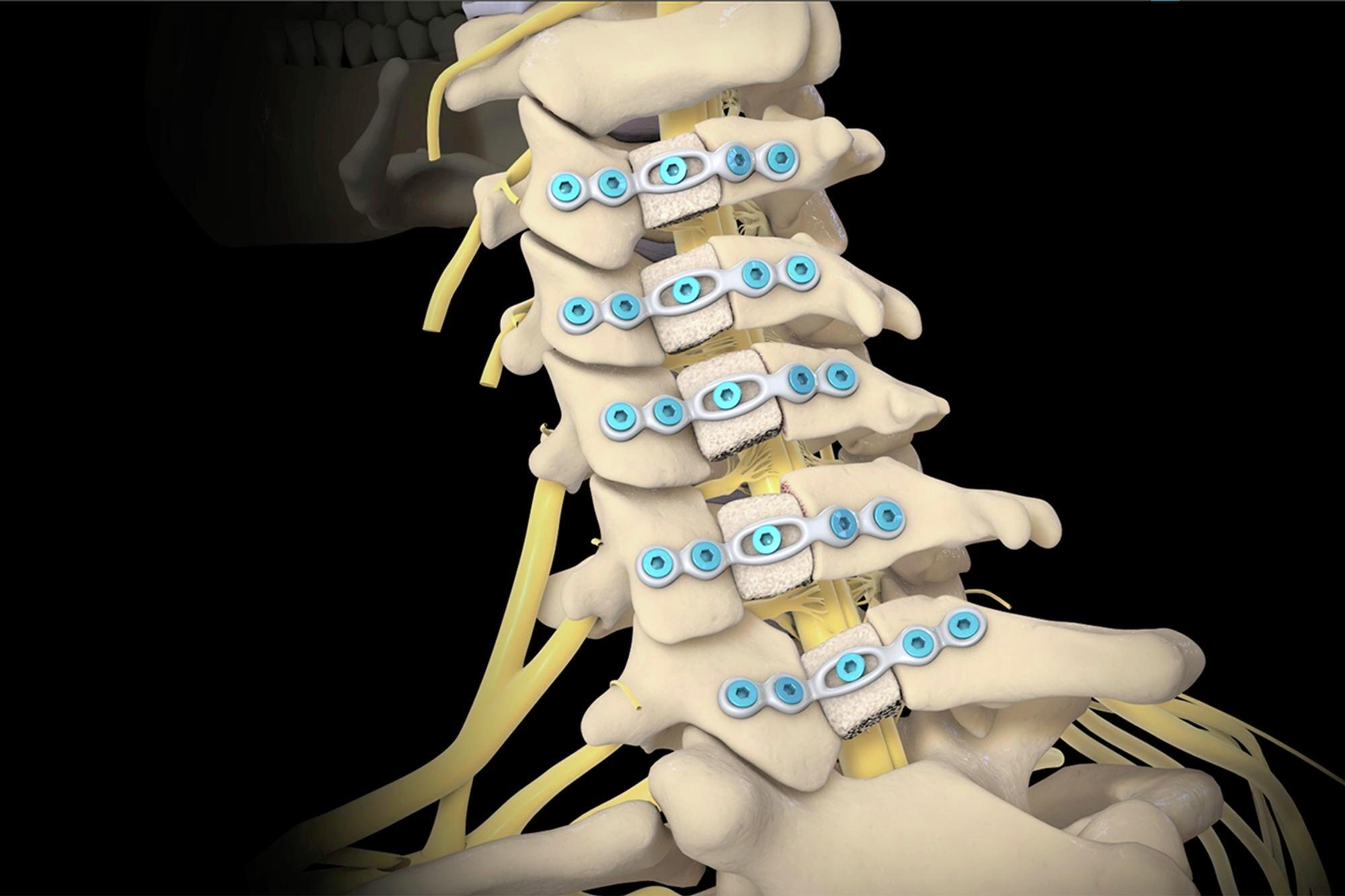 Lumbar Spinal Stenosis  Columbia Orthopaedic Group