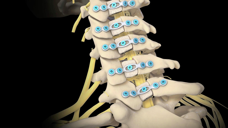 Cervical Laminoplasty.jpg