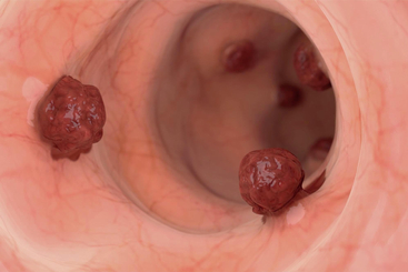 Understanding Colorectal Cancer.jpg