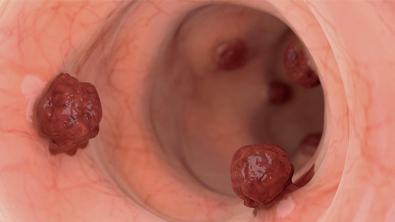 Understanding Colorectal Cancer.jpg