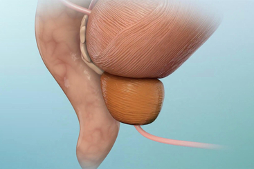 Understanding Prostate Cancer.jpg