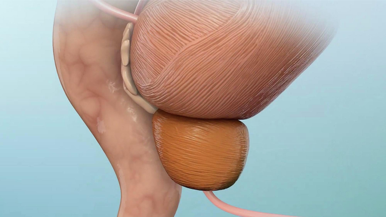 Understanding Prostate Cancer.jpg