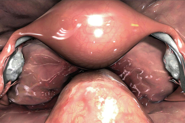 Diagnostic Pelvic Laparoscopy.jpg