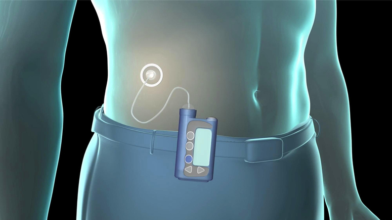 Insulin Pump.jpg