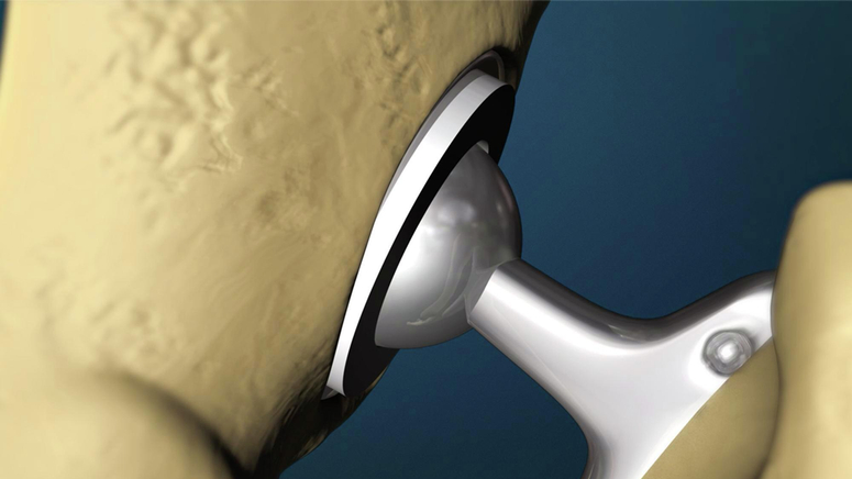 Total Hip Replacement.jpg