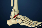Lateral Transfibular Ankle Fusion.jpg