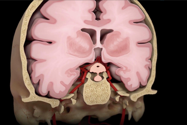 Cerebral Aneurysm.jpg