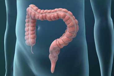 Treatments for Colorectal Cancer.jpg