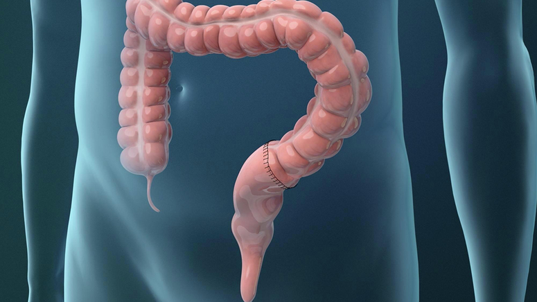 Treatments for Colorectal Cancer.jpg