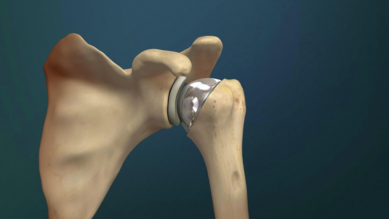 Total Shoulder Replacement.jpg