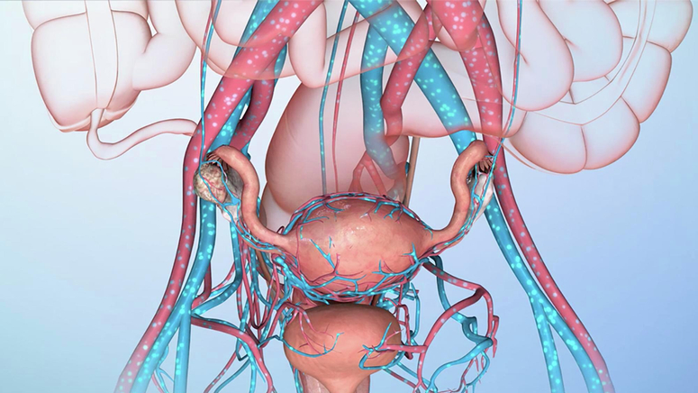 Treatment Options for Ovarian Cancer.jpg