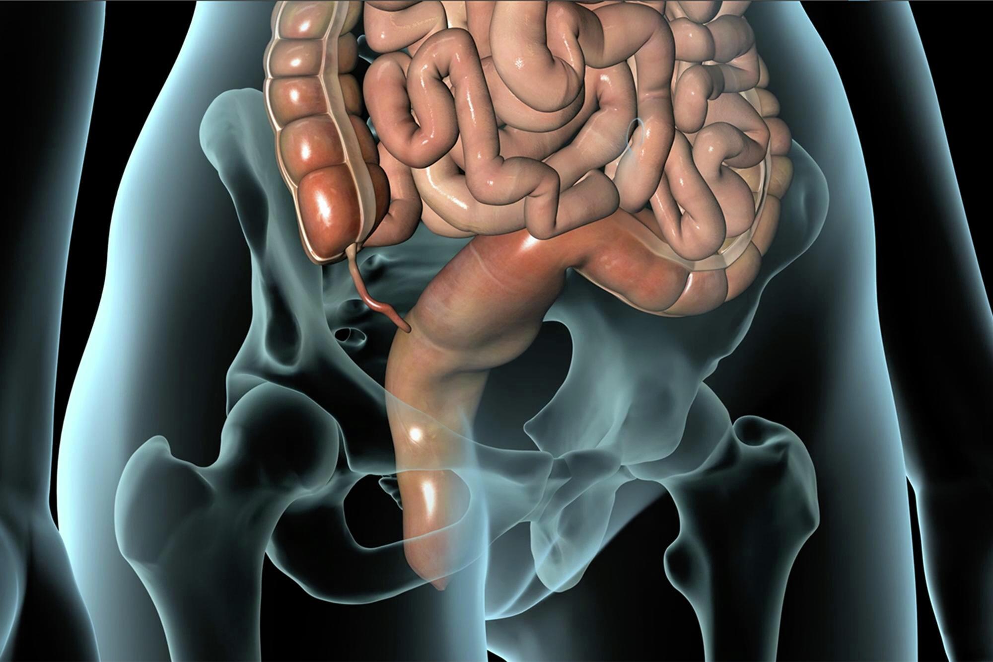 Hemorrhoids, swollen and inflamed veins in the lower rectum, treated by GI specialists at Mercy Medical Center, Baltimore.