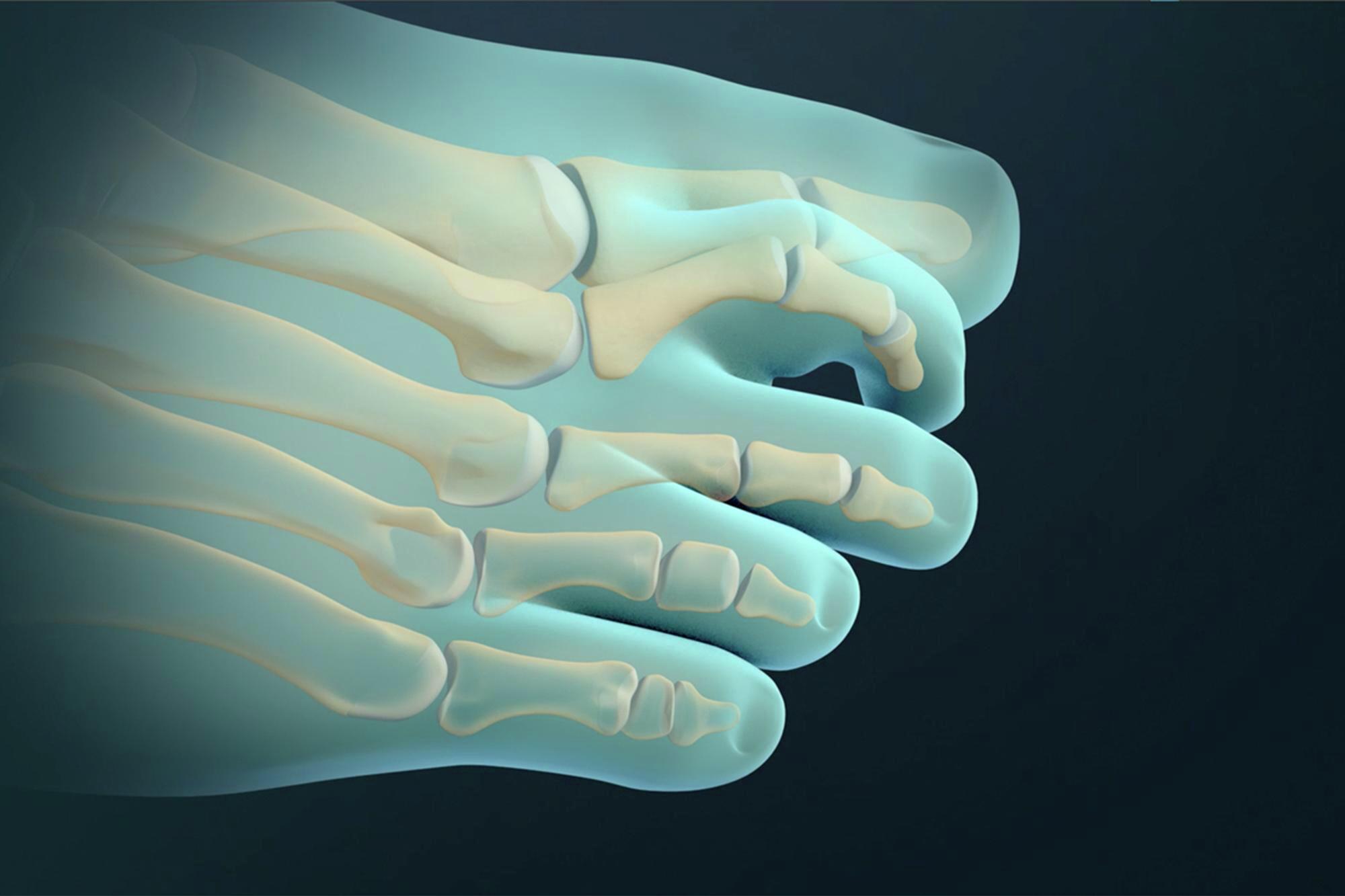 Hammer Toe Correction Treatment Offered by Top Foot Doctor in Baltimore