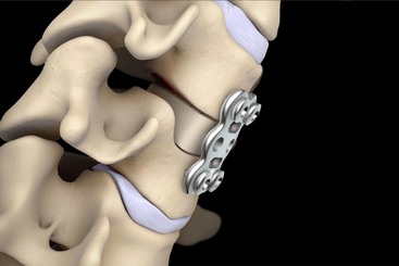 Anterior Cervical Discectomy and Fusion.jpg