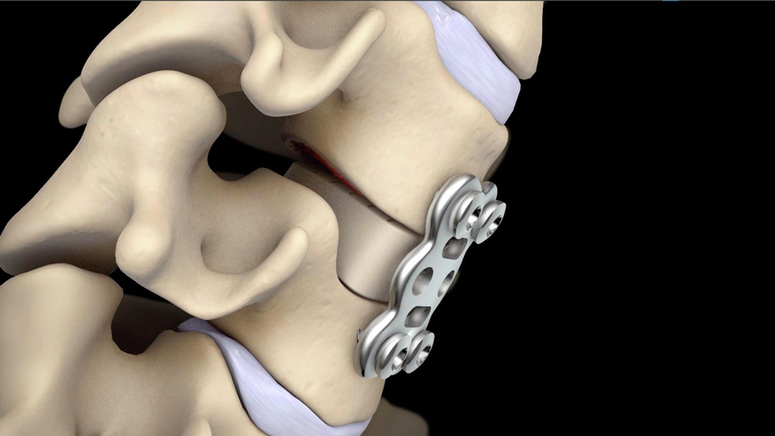 Anterior Cervical Discectomy and Fusion.jpg