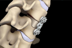 Anterior Cervical Discectomy and Fusion.jpg