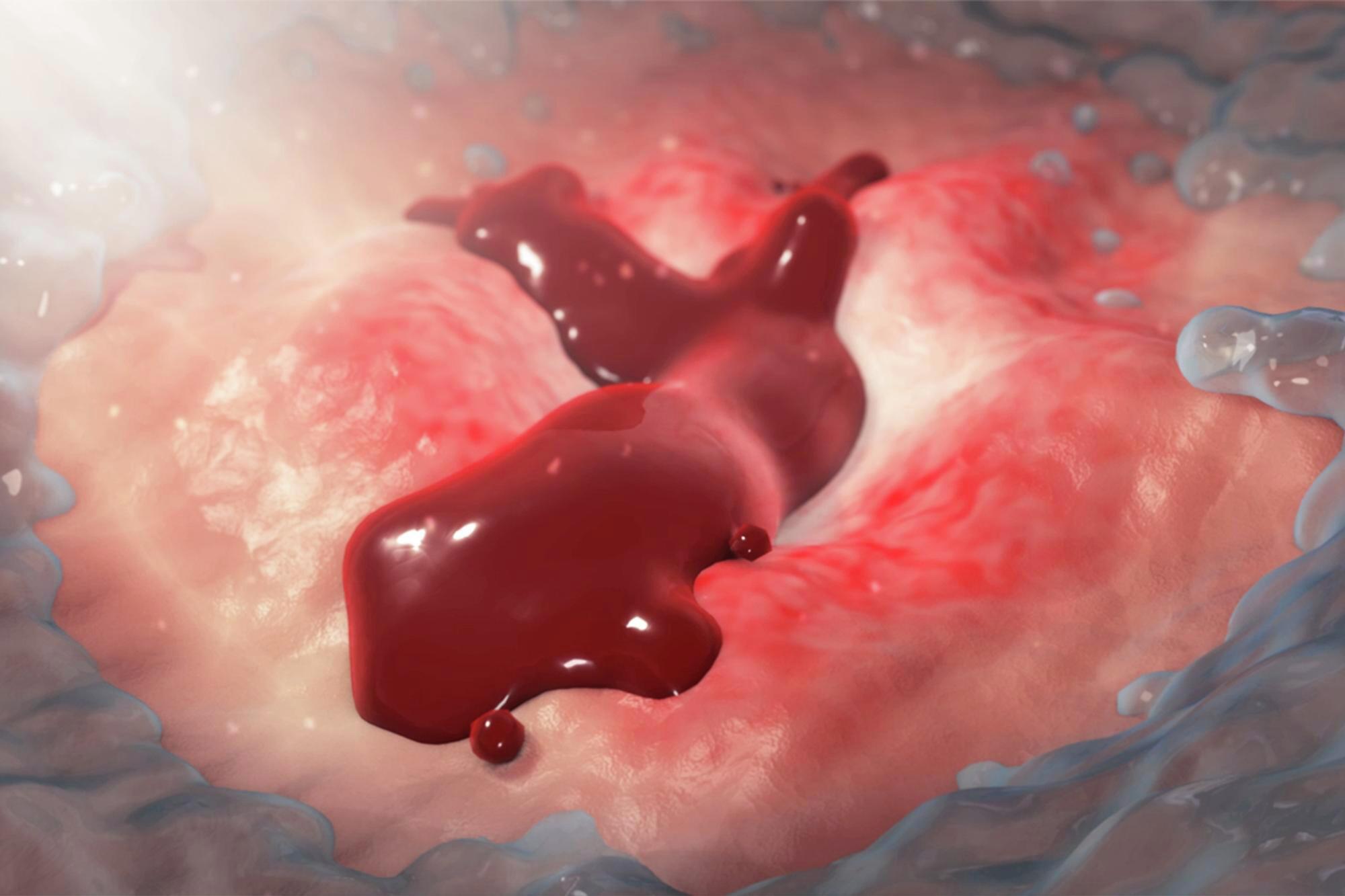 Peptic Ulcer Disease Causes, Symptoms, Treatment Options Mercy