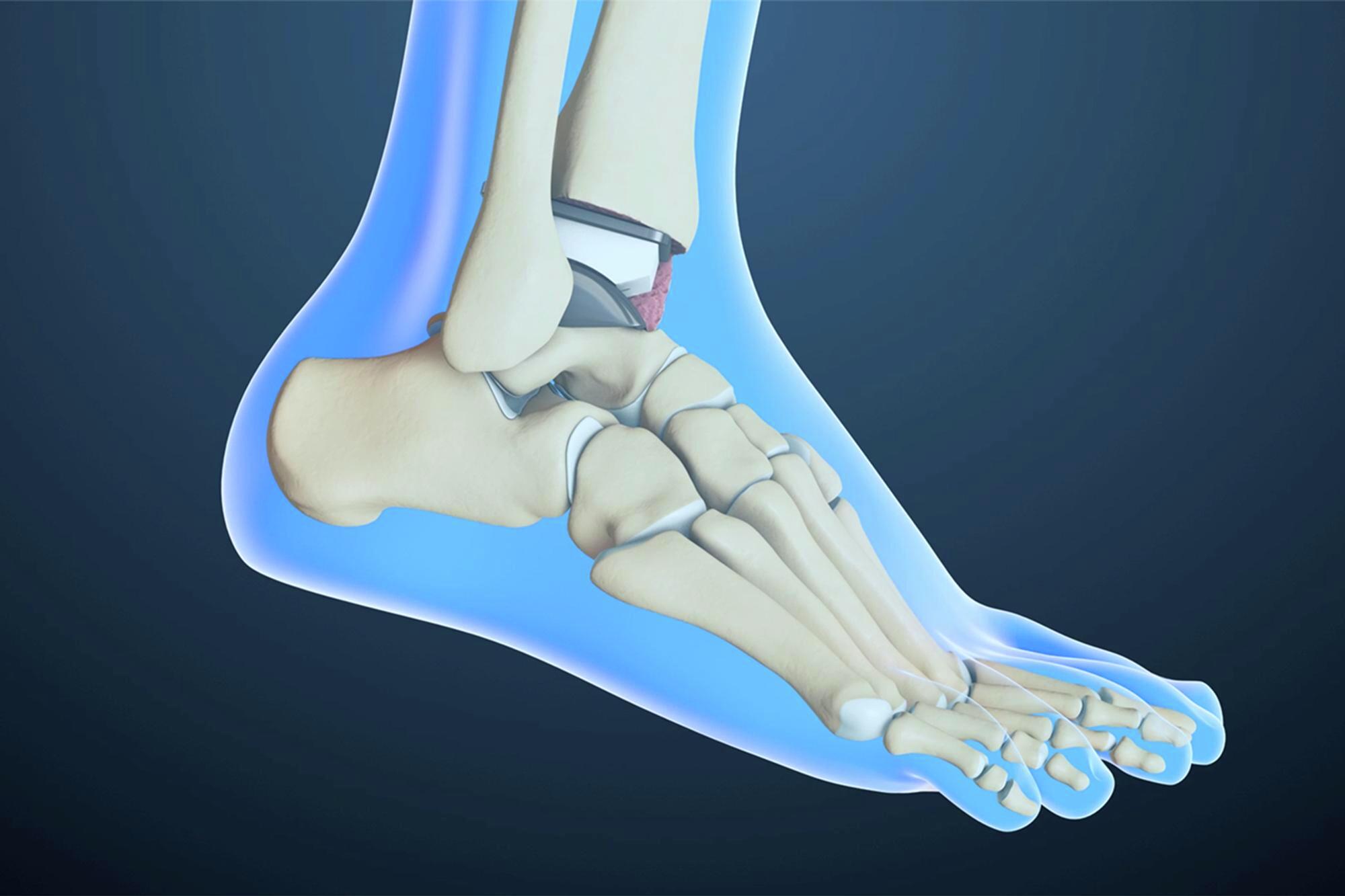 Ankle Replacement — Ankle Arthritis, Ankle Replacement, Arthrodesis