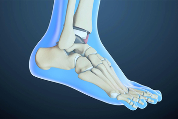 Ankle Replacement.jpg