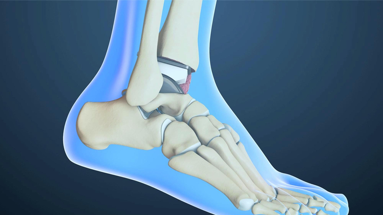 Ankle Replacement.jpg