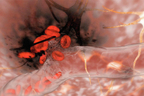 Hemorrhagic Stroke.jpg