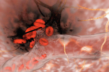 Hemorrhagic Stroke.jpg