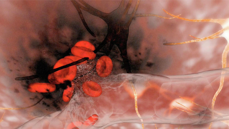 Hemorrhagic Stroke.jpg